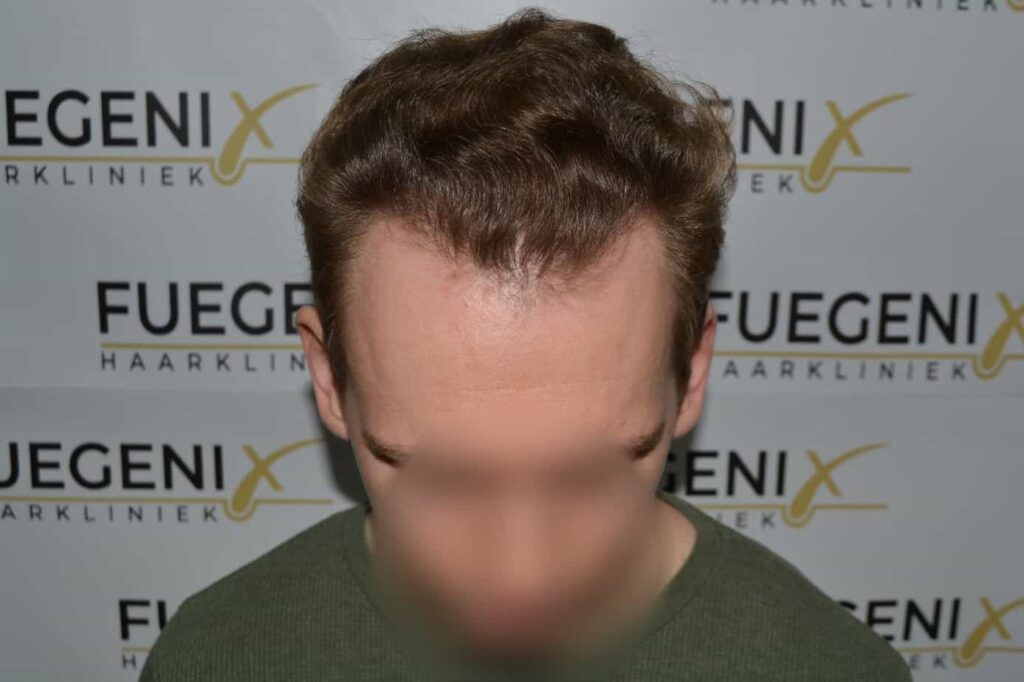 Soft Dense Hairline