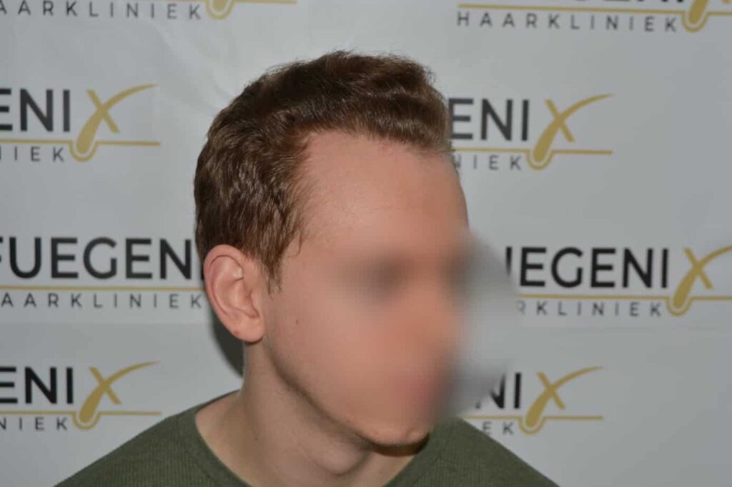 Soft Dense Hairline