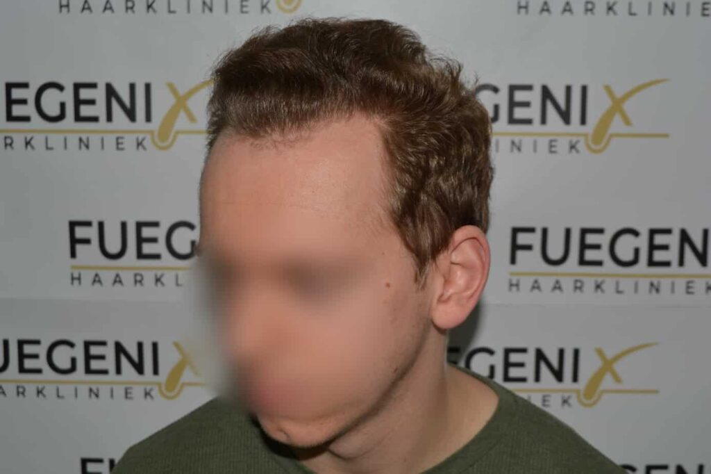 Soft Dense Hairline