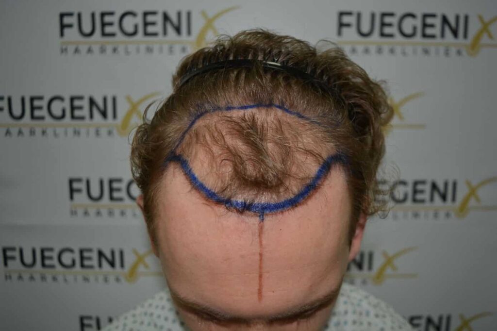 Soft Dense Hairline