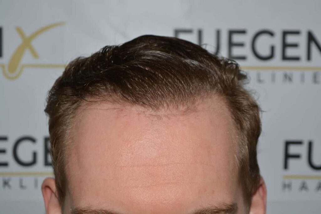Soft Dense Hairline