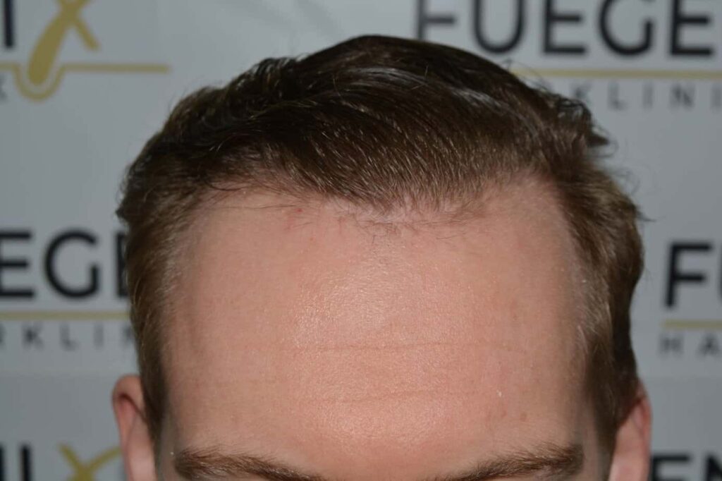 Soft Dense Hairline
