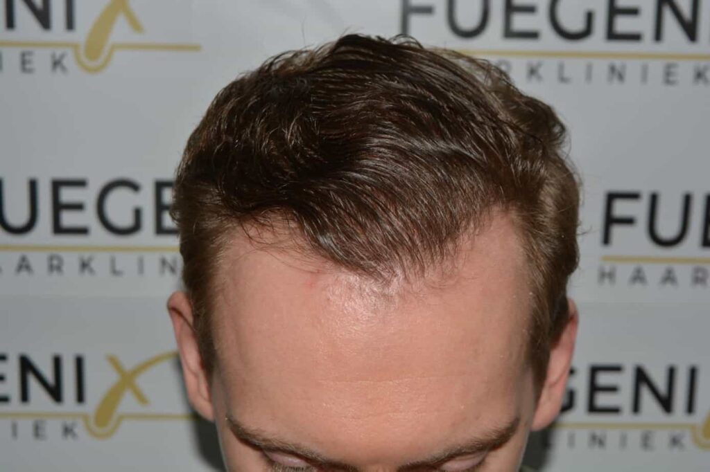 Soft Dense Hairline