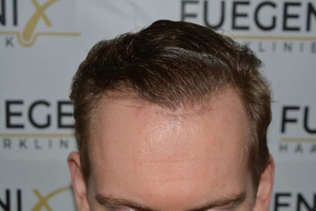 Soft Dense Hairline