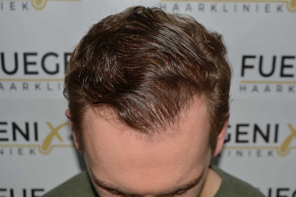 Soft Dense Hairline