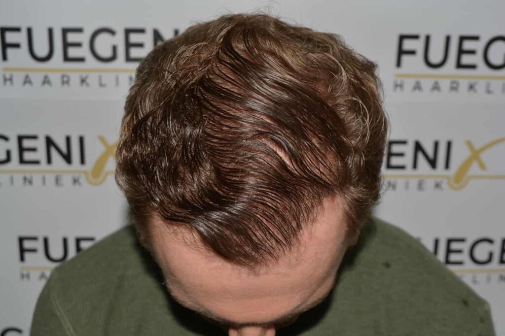 Soft Dense Hairline