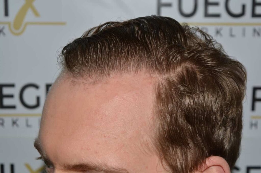 Soft Dense Hairline