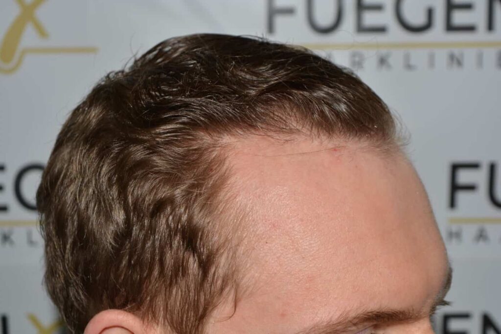 Soft Dense Hairline