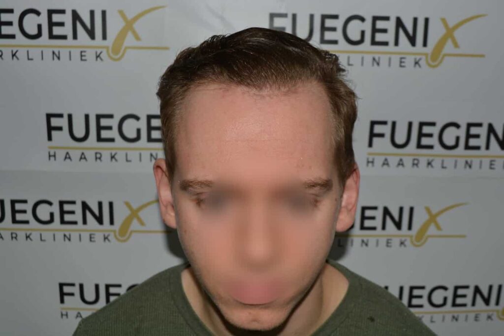 Soft Dense Hairline