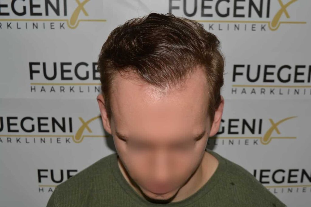 Soft Dense Hairline