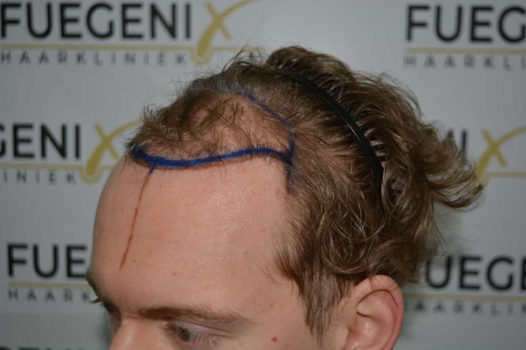 Soft Dense Hairline