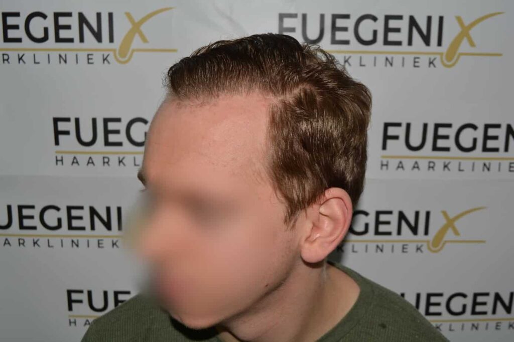Soft Dense Hairline