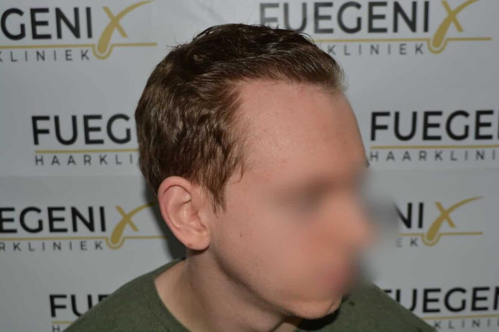Soft Dense Hairline