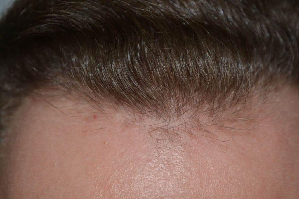 Soft Dense Hairline