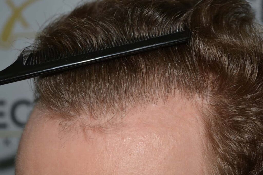Soft Dense Hairline