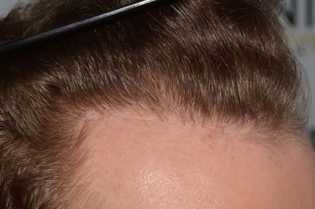 Soft Dense Hairline