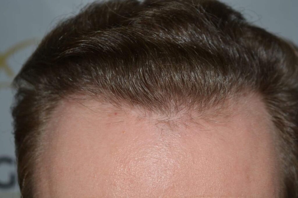 Soft Dense Hairline