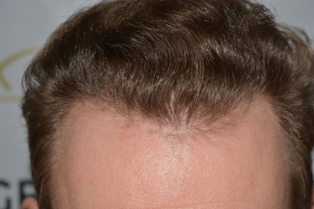 Soft Dense Hairline
