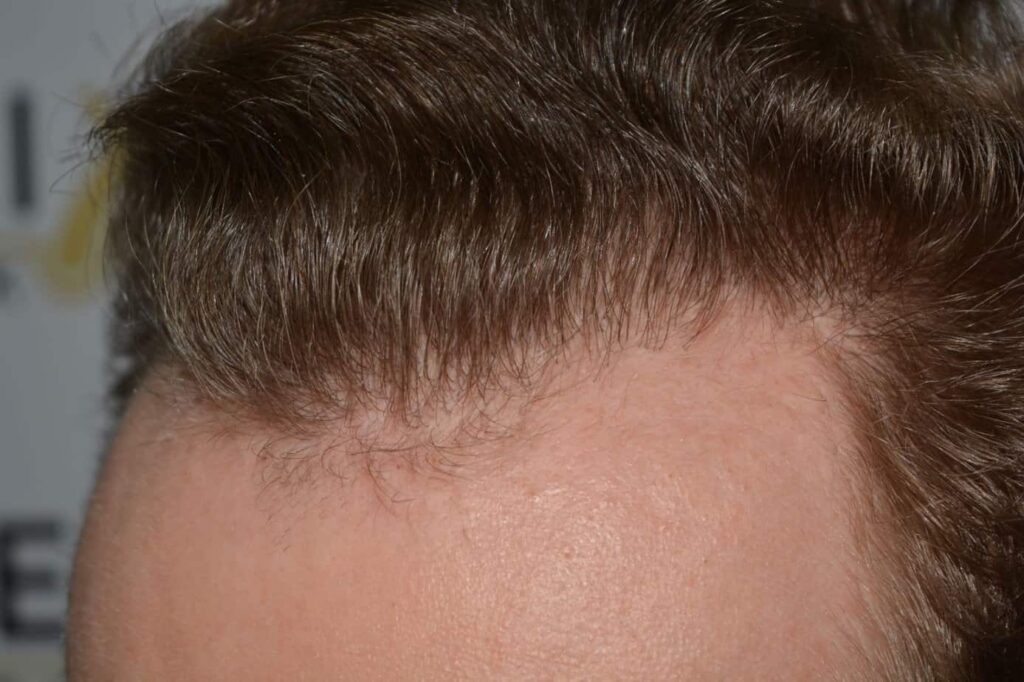 Soft Dense Hairline