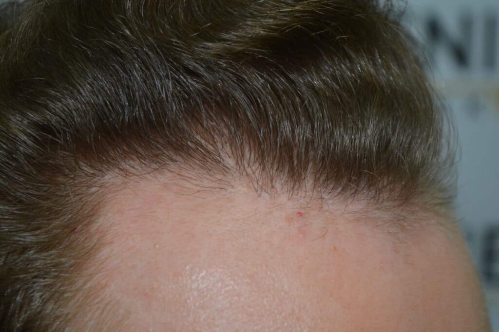 Soft Dense Hairline