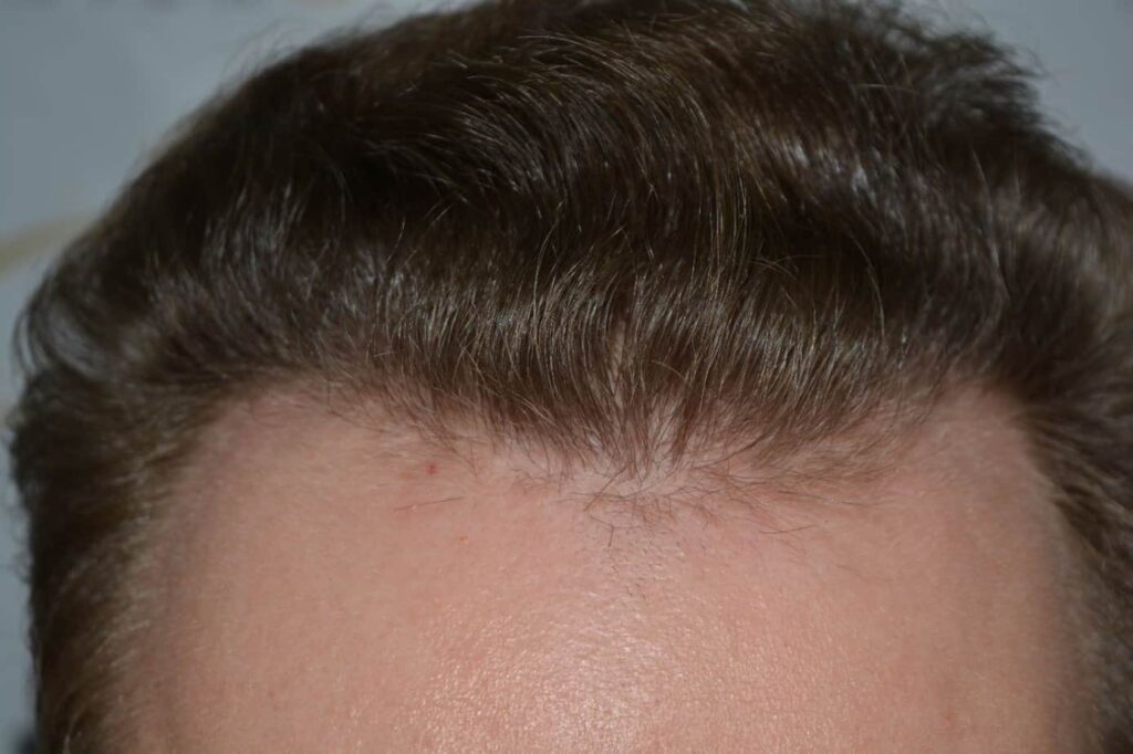 Soft Dense Hairline
