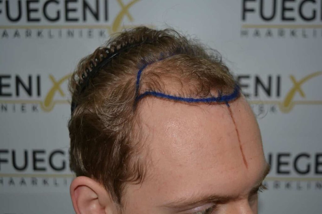 Soft Dense Hairline
