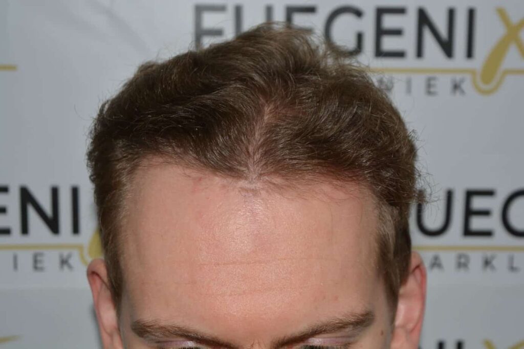Soft Dense Hairline