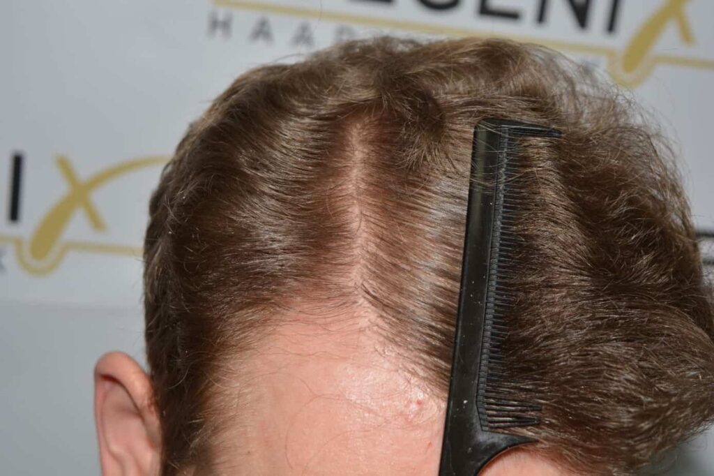 Soft Dense Hairline