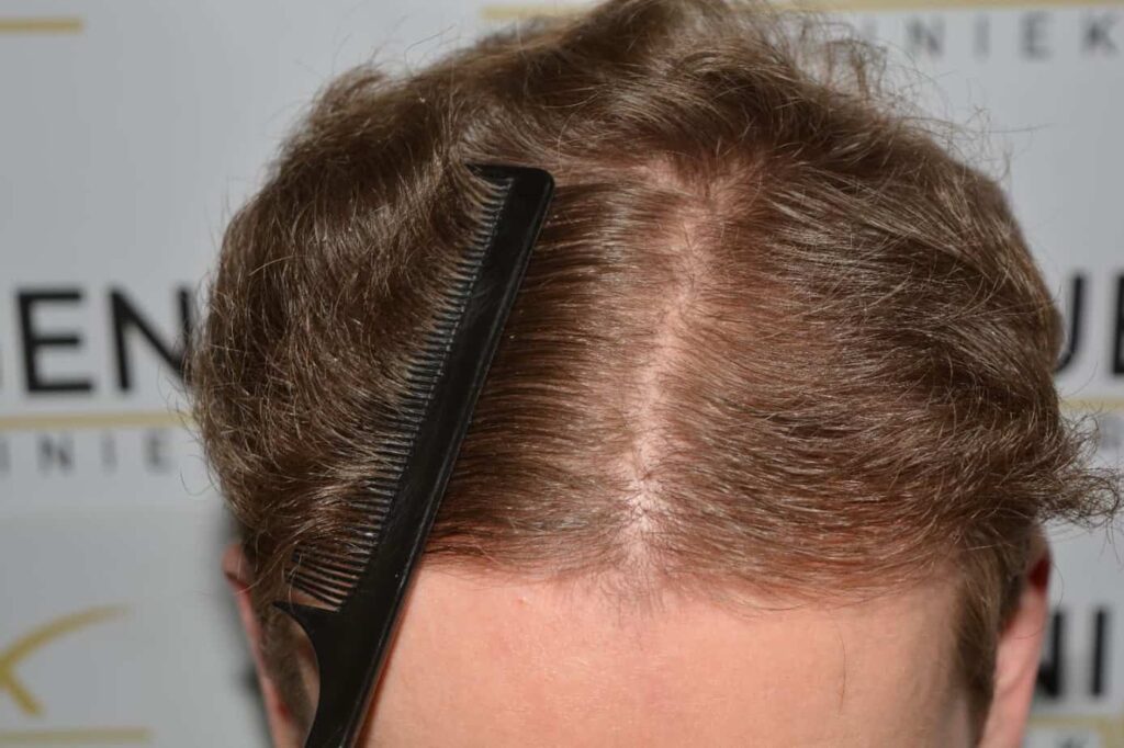 Soft Dense Hairline