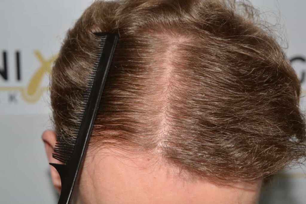 Soft Dense Hairline