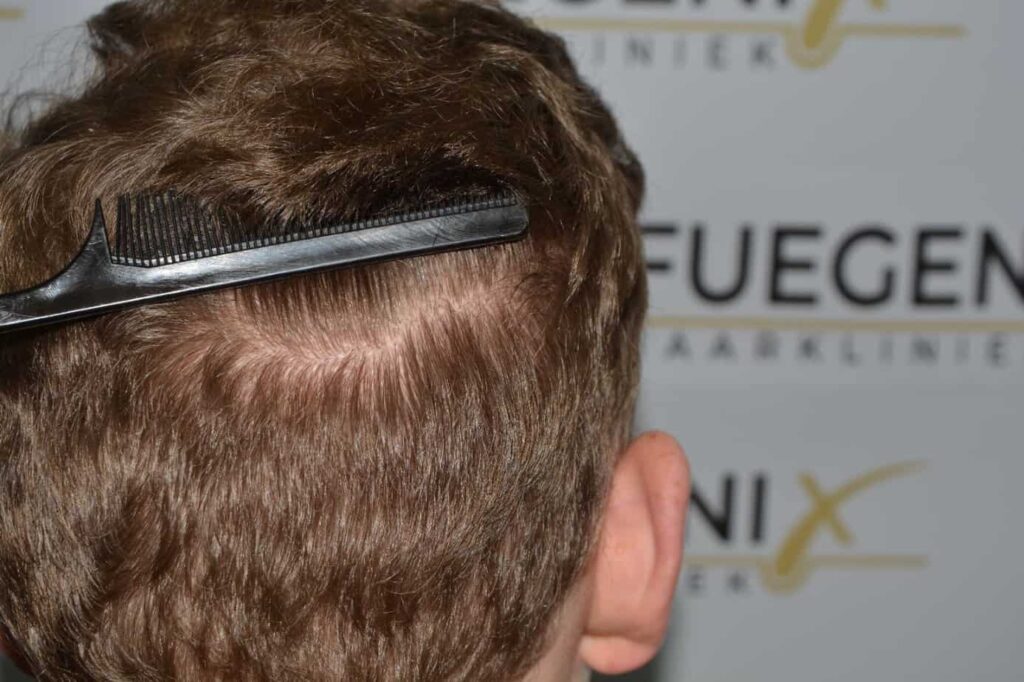 Soft Dense Hairline