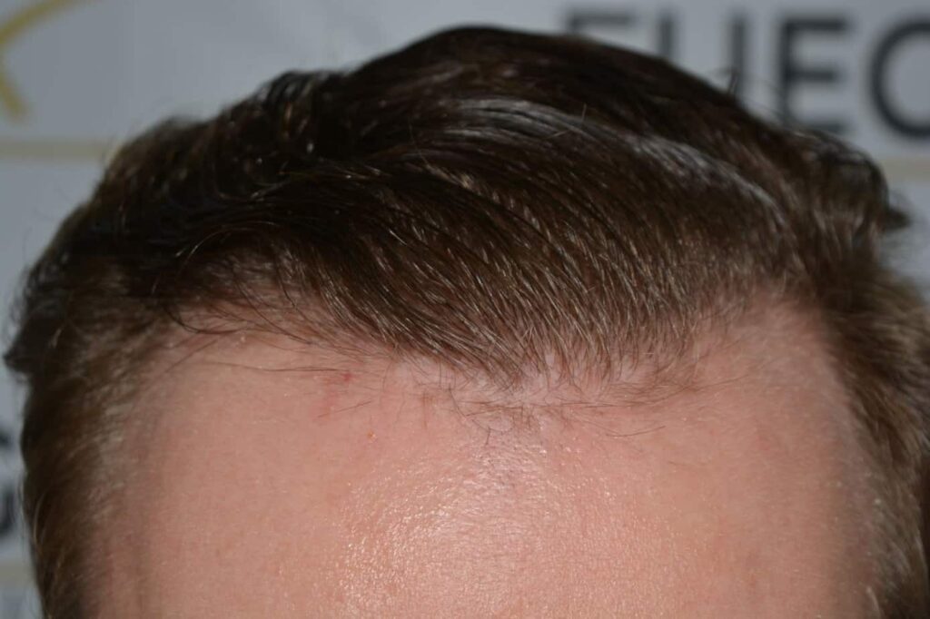 Soft Dense Hairline