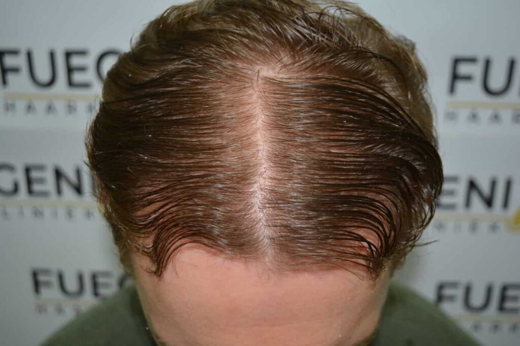 Soft Dense Hairline