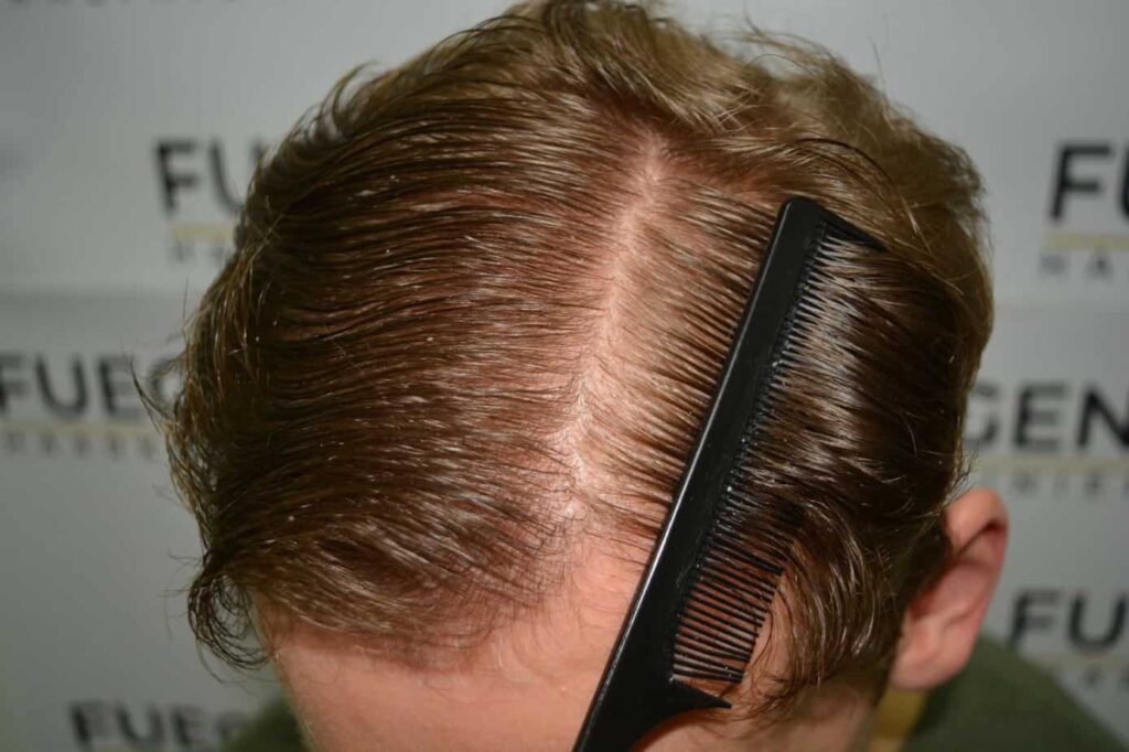 Soft Dense Hairline