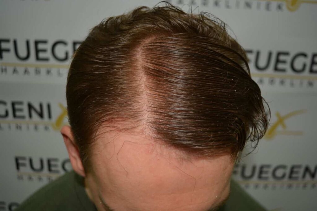 Soft Dense Hairline