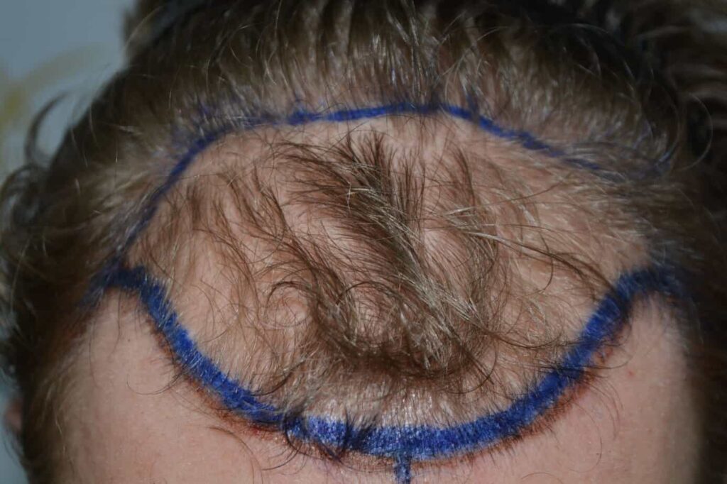 Soft Dense Hairline