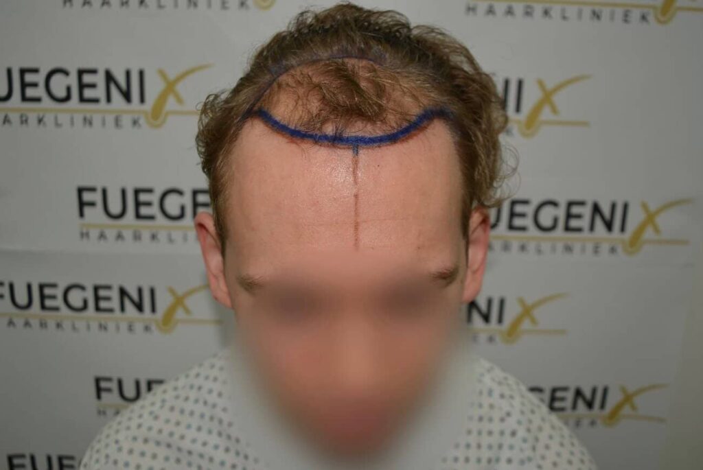 Soft Dense Hairline