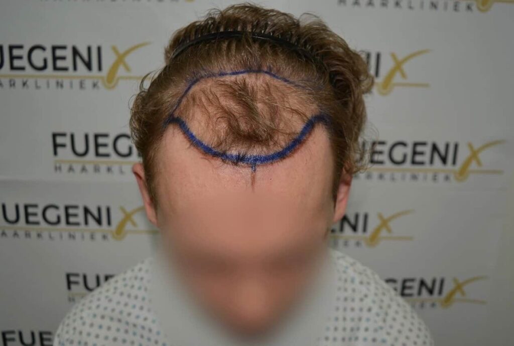 Soft Dense Hairline