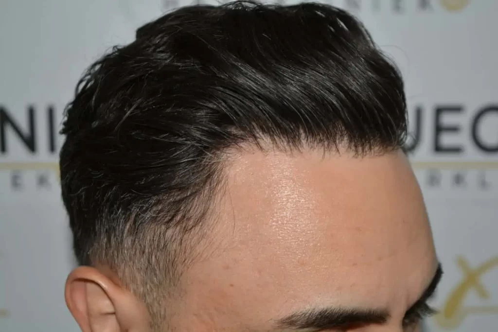 The Bollywood Hairline
