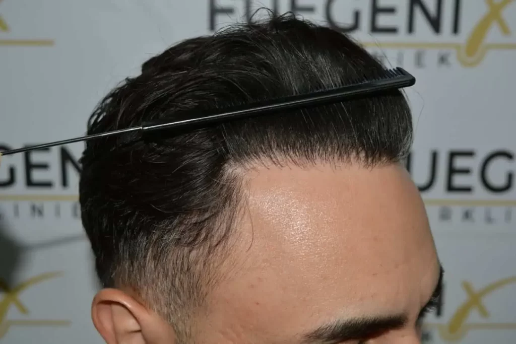 The Bollywood Hairline