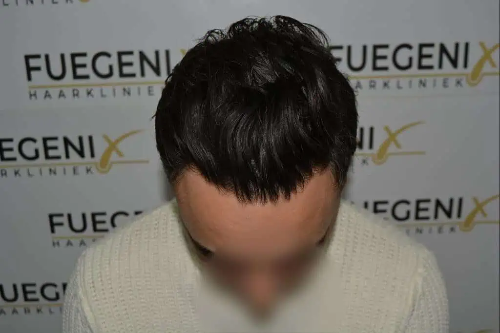 The Bollywood Hairline