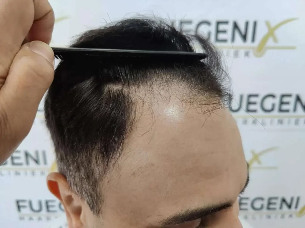 The Bollywood Hairline