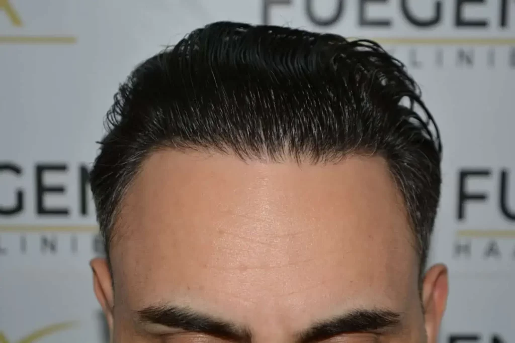 The Bollywood Hairline