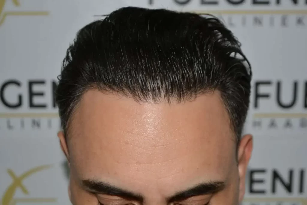 The Bollywood Hairline