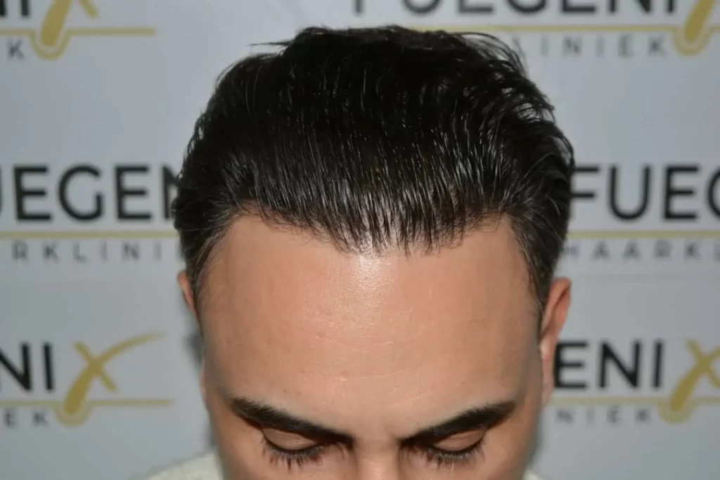 The Bollywood Hairline