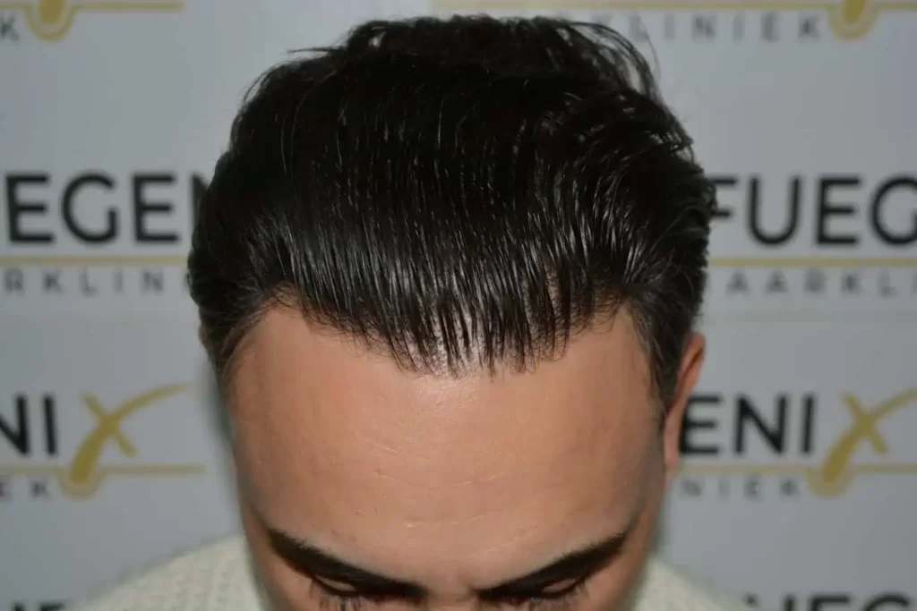 The Bollywood Hairline