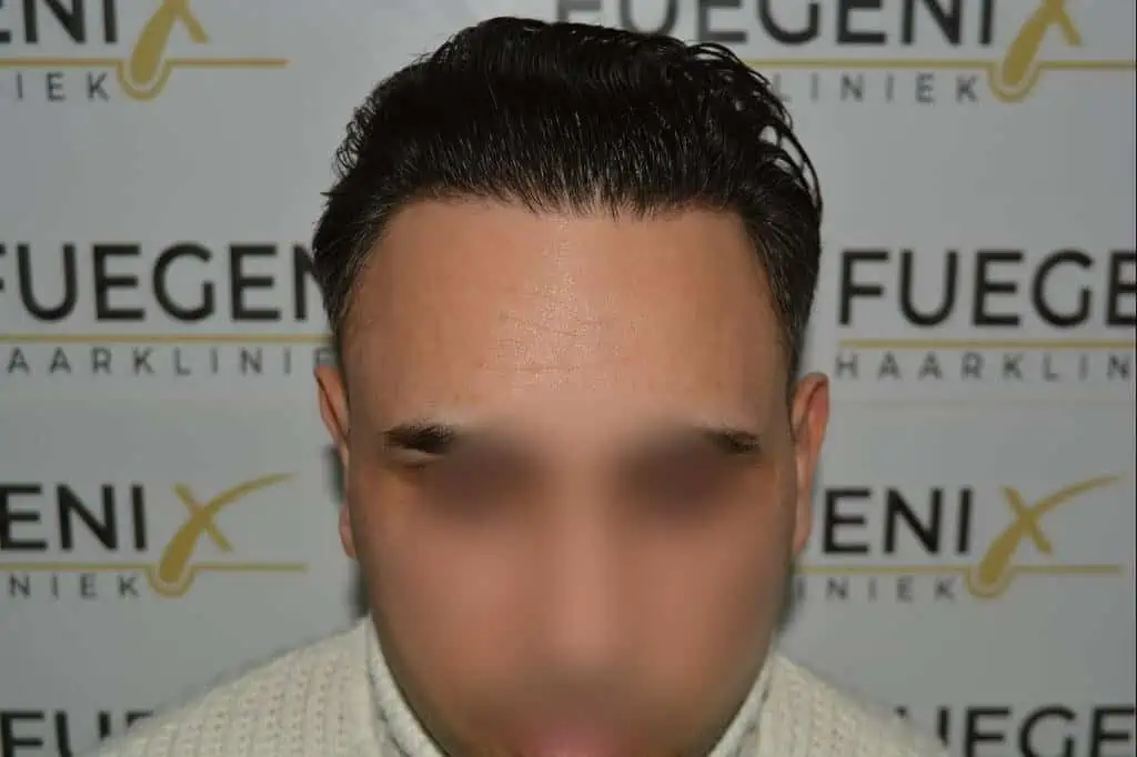The Bollywood Hairline