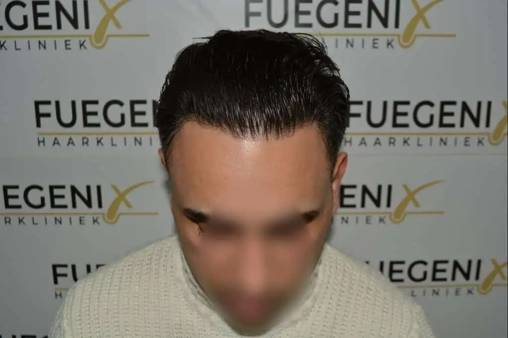 The Bollywood Hairline