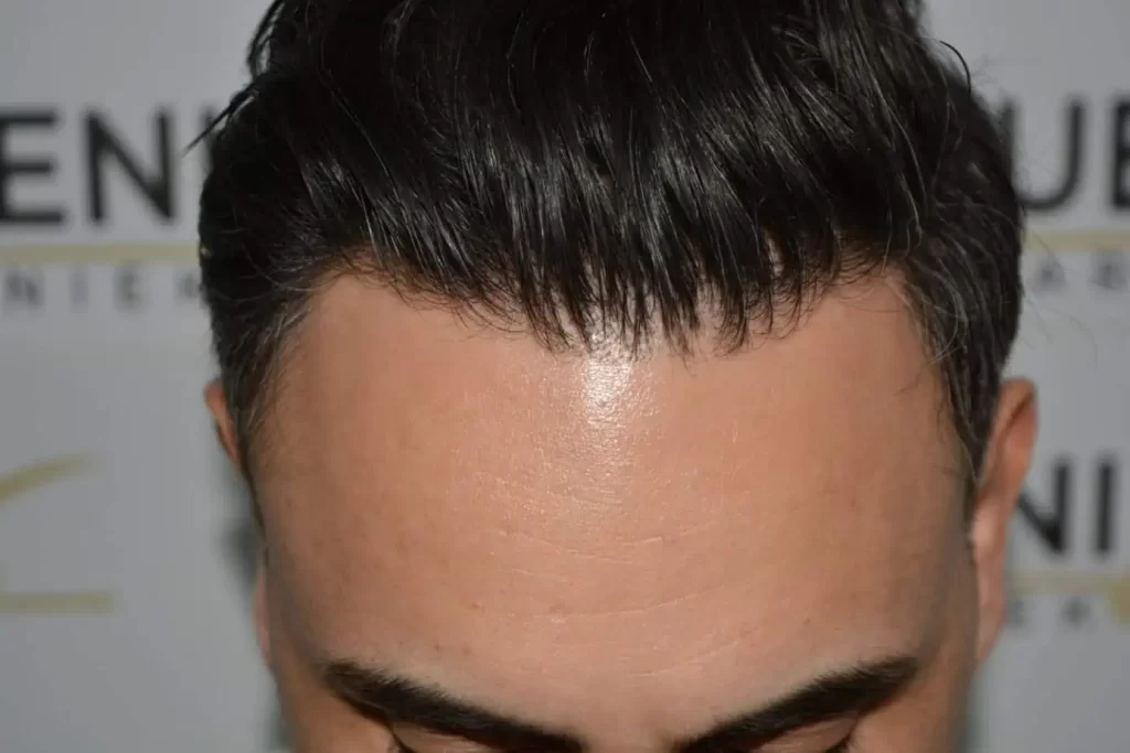 The Bollywood Hairline