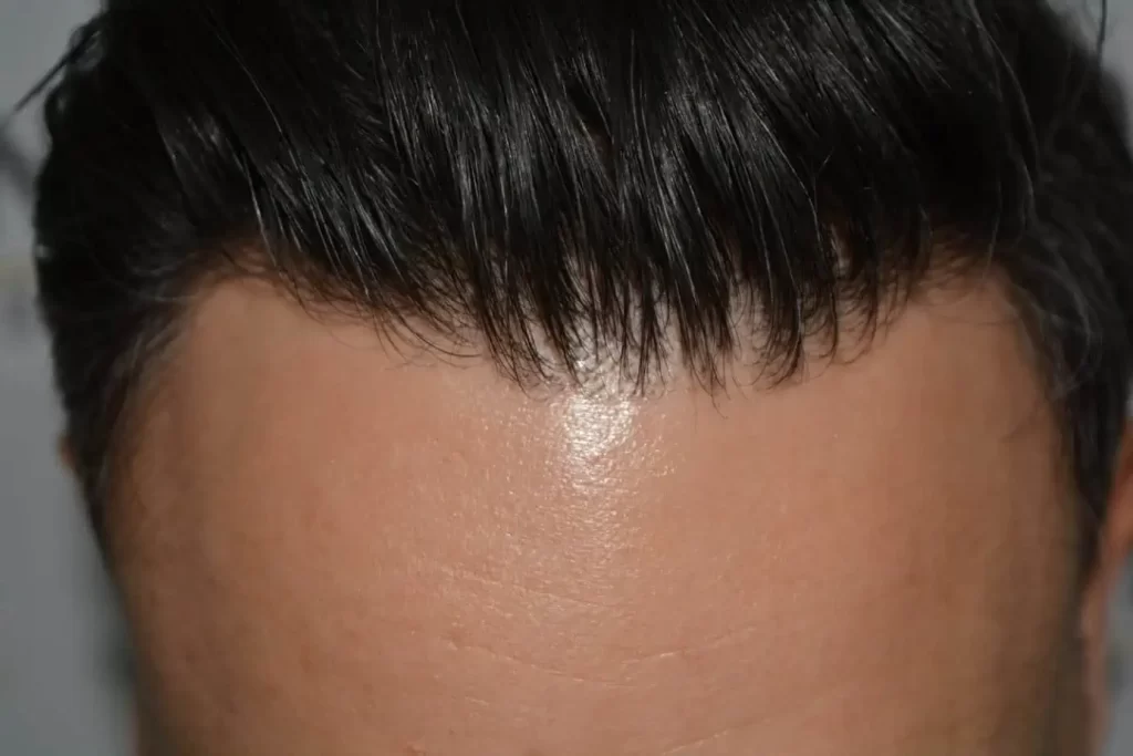 The Bollywood Hairline